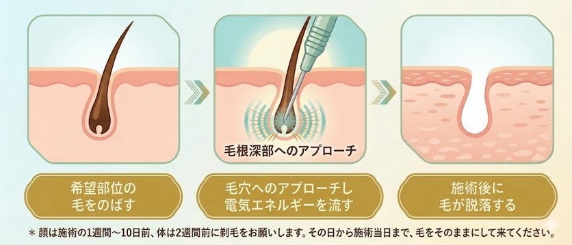 ニードル脱毛（医療針脱毛）のメカニズム